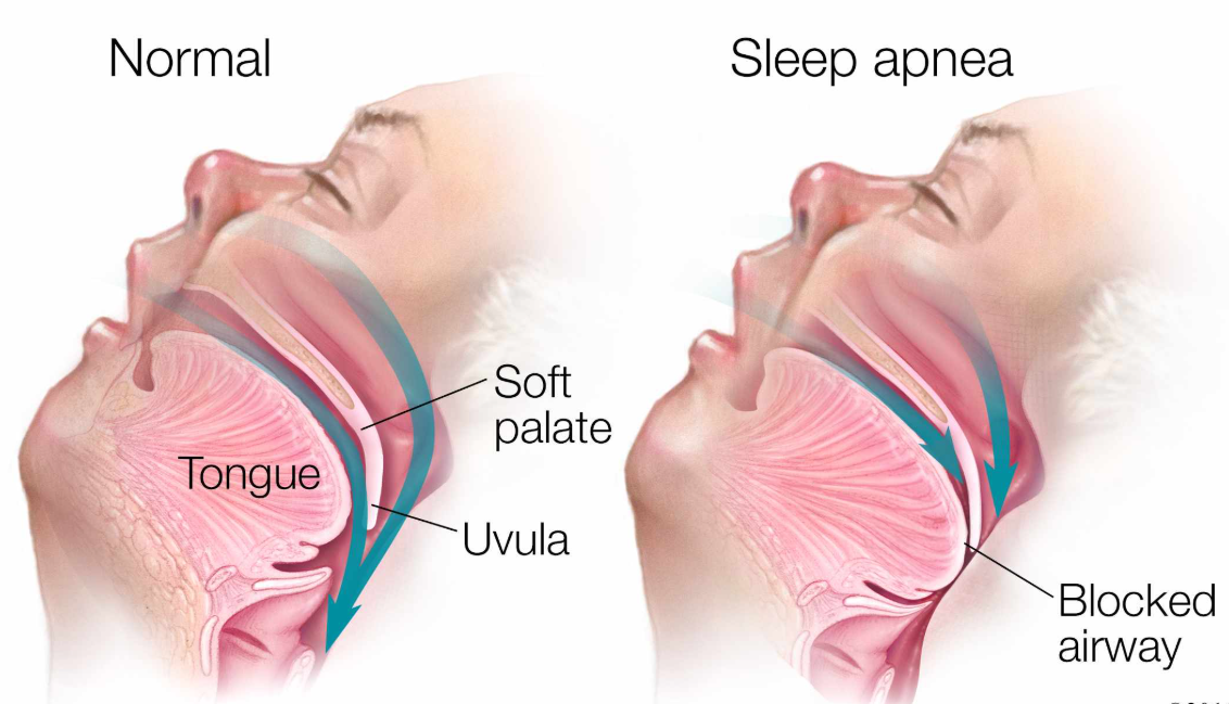Sleep Apnea